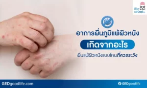 อาการผื่นภูมิแพ้ผิวหนังเกิดจากอะไร ผื่นแพ้ผิวหนังแบบไหนที่ควรระวัง